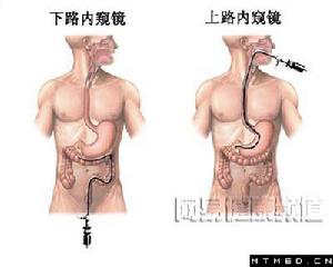 下消化道出血