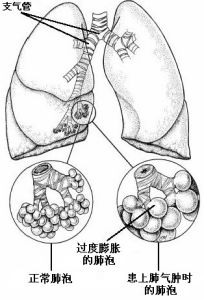 先天性腹膜疝