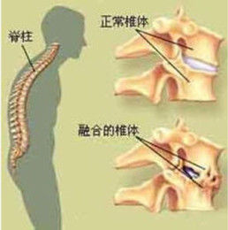 強直性脊柱炎