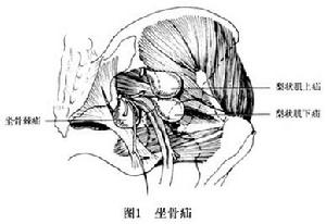 坐骨疝 圖1