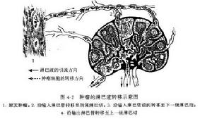 淋巴道轉移