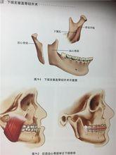 下頜升支矢狀截骨術