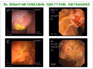 （圖）壺腹周圍癌