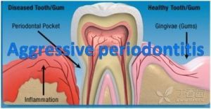 侵襲性牙周炎