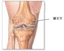 小兒賴特綜合徵