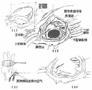 妊娠合併心房間隔缺損