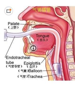 哮喘持續狀態