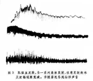 先天性副肌強直症