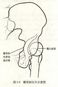 髖臼角