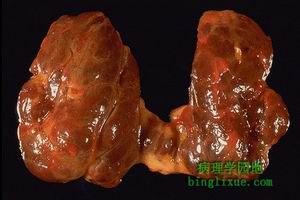 結節性甲狀腺腫