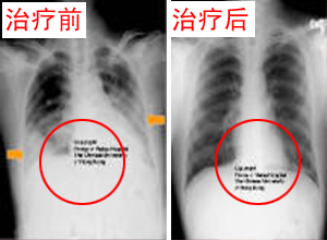 胸壁結核