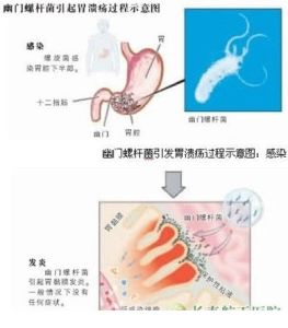 幽門螺桿菌感染