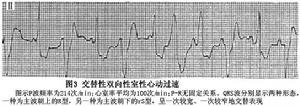 雙向性室性心動過速