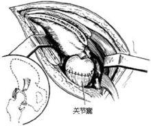 示意圖8:復位關節，重疊縫合關節囊