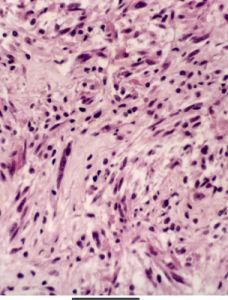 膠質母細胞瘤