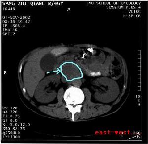 原發性腹膜後腫瘤