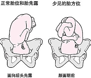 胎位異常