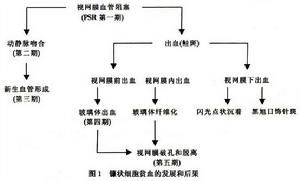 （圖）鐮狀細胞貧血眼部病變