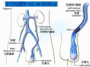 靜脈曲張