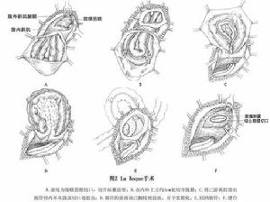 腹股溝滑動疝 圖2