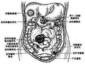 腹膜炎