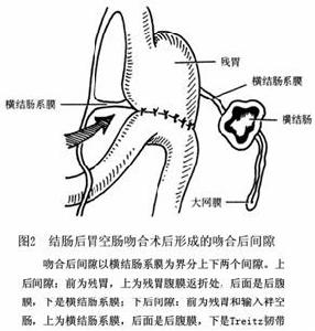 胃切除術後內疝