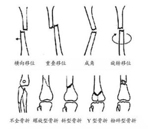 移位骨折