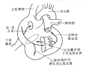 埃勃斯坦畸形