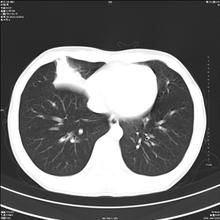 小兒右肺中葉綜合徵