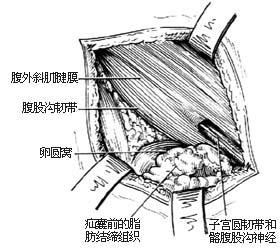 老人腹股溝斜疝