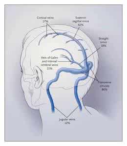 大腦靜脈血栓形成