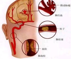 腦梗塞