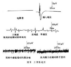 酒中毒性周圍神經病