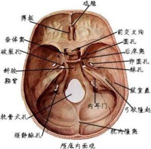 顱中窩骨折