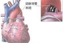 先天性心包缺如或缺損