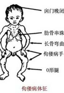 新生兒佝僂病