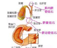 膽道結石