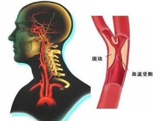 腦動脈硬化