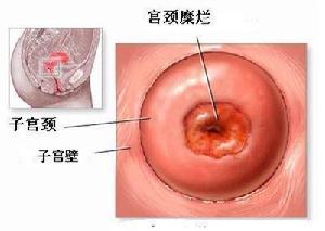 （圖）宮頸糜爛