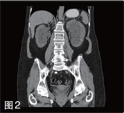 囊性腎病