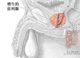 前列腺增生