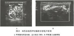 （圖）毒性瀰漫性甲狀腺腫