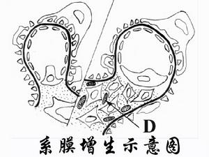 膜增生性腎小球腎炎