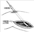 代股四頭肌手術