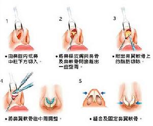 鼻孔縮小手術過程