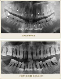 牙槽骨吸收