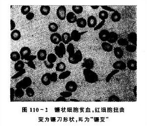 （圖）鐮狀細胞貧血眼部病變