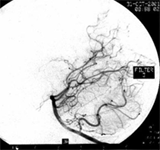 先天性腦血管畸形