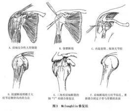 肩袖損傷康復