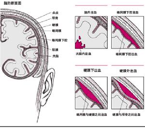 新生兒顱內出血